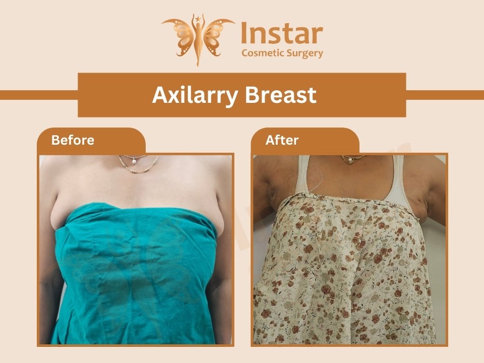 Axilarry-Breast-2