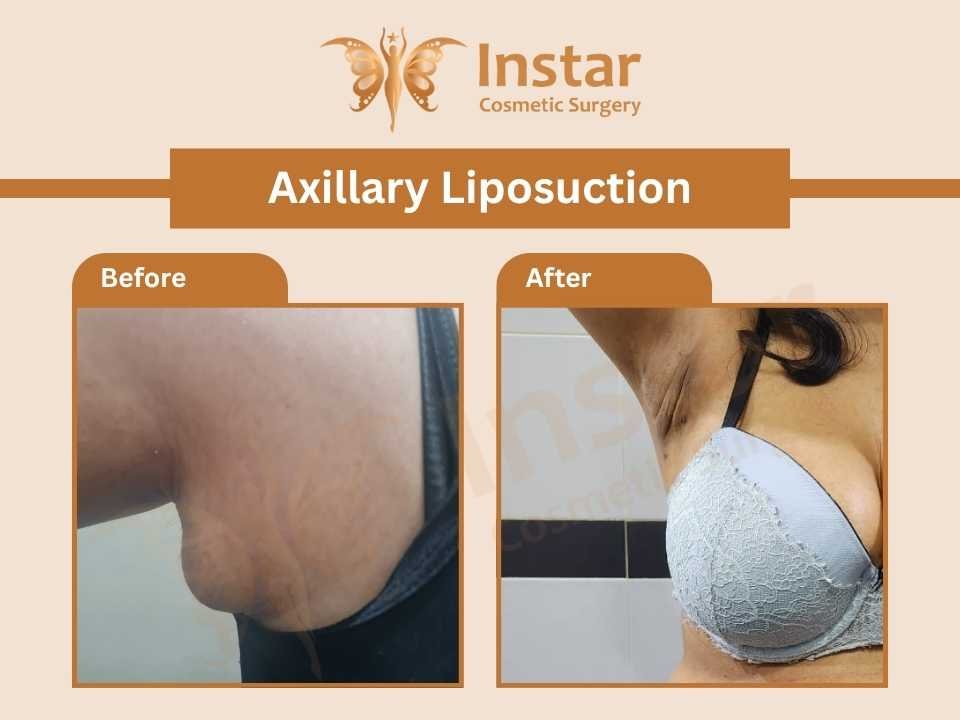 Axillary-breast-liposuction