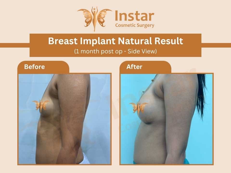 Breast-Implant-Natural-Result-1-month-post-op-Side-View