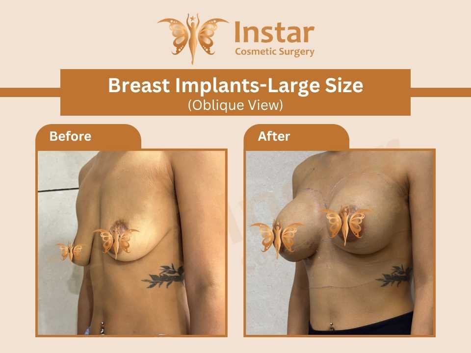 Breast-Implants-Large-Size-oblique-View