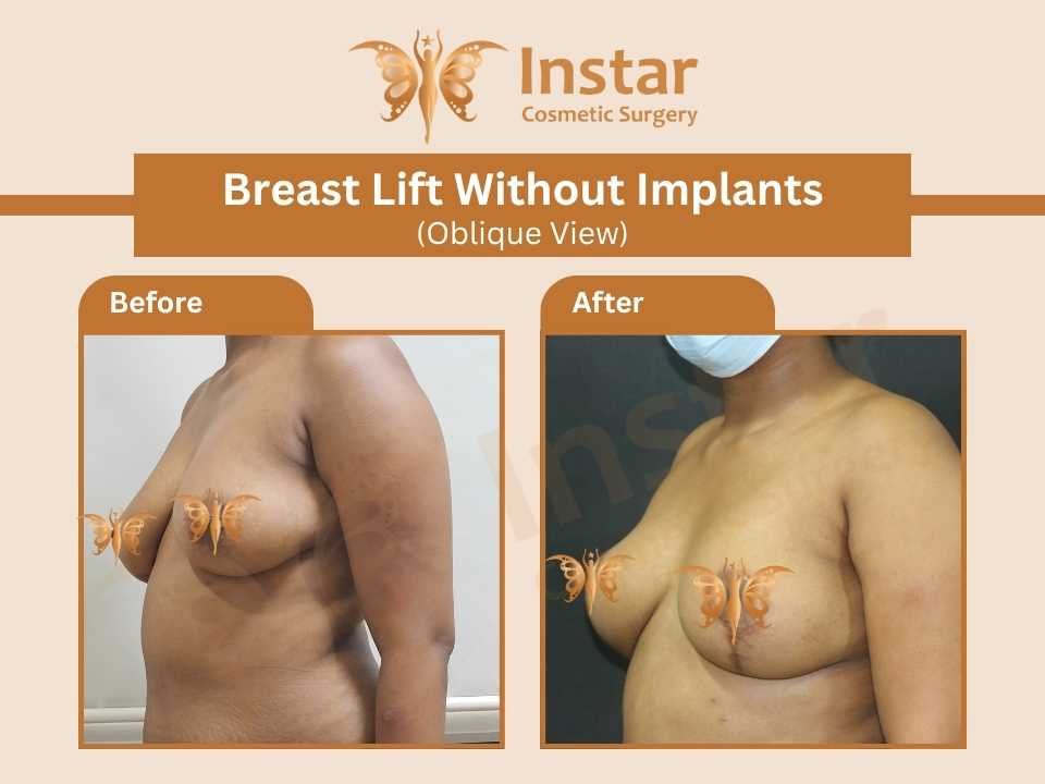 Breast-lift-without-implants-Oblique-view-1