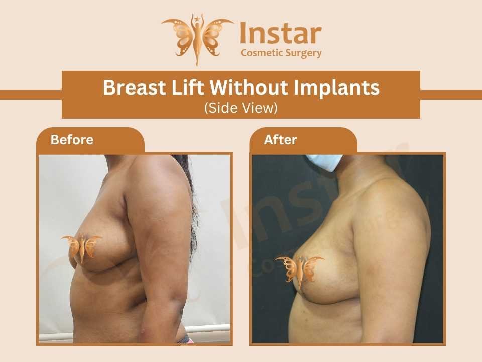 Breast-lift-without-implants-side-view-1