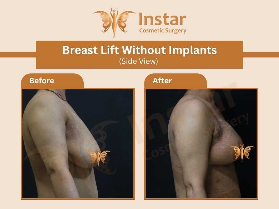Breast-lift-without-implants-side-view-2