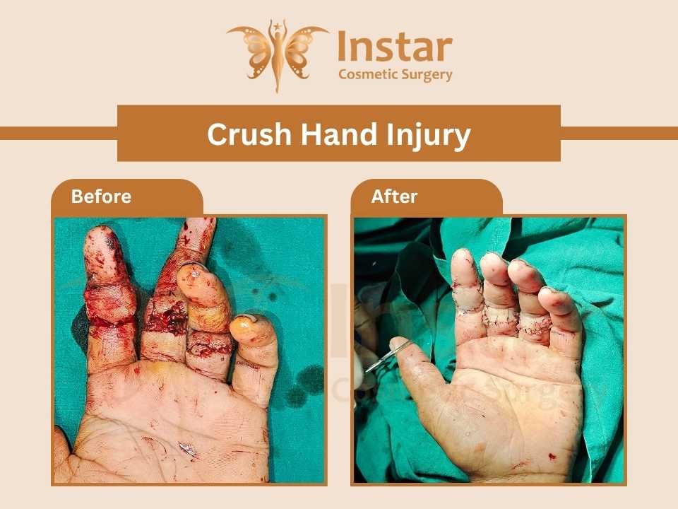Crush-Hand-Injury-1
