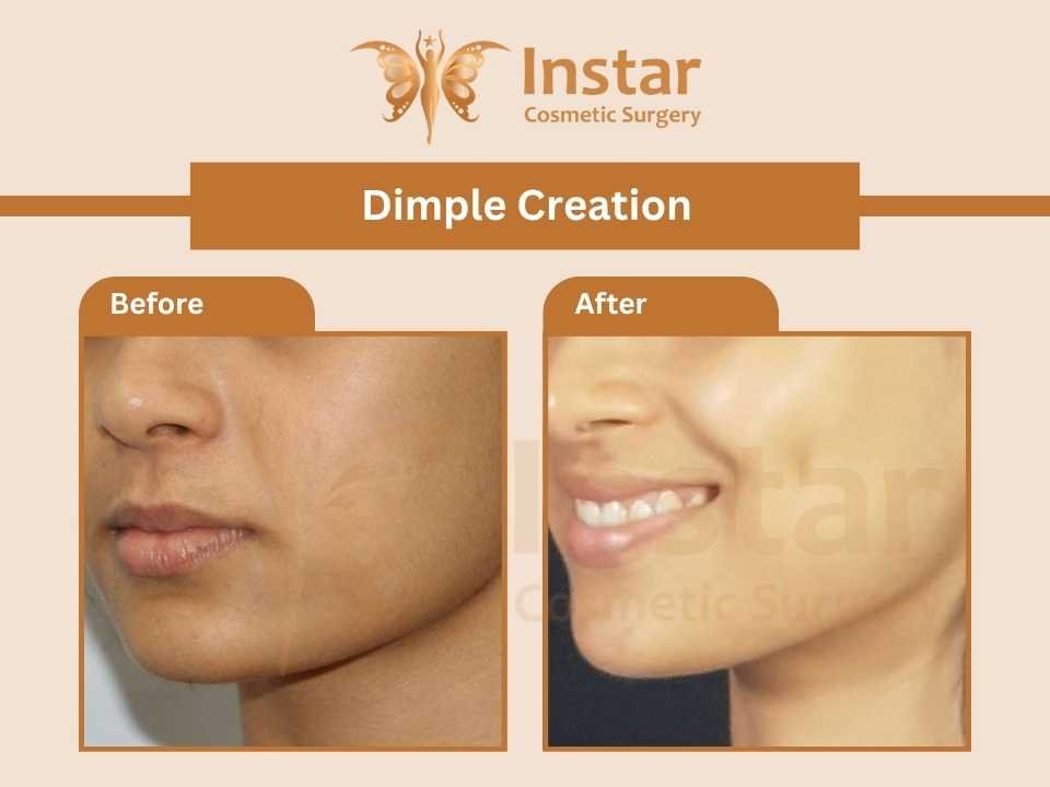 Dimple-creation-1