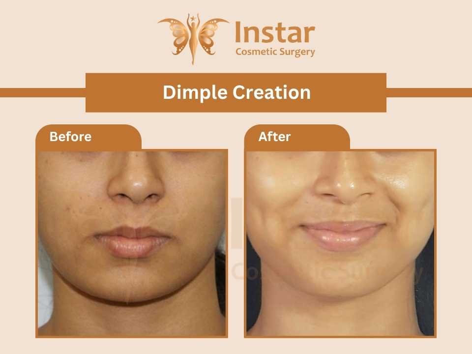 Dimple-creation-2