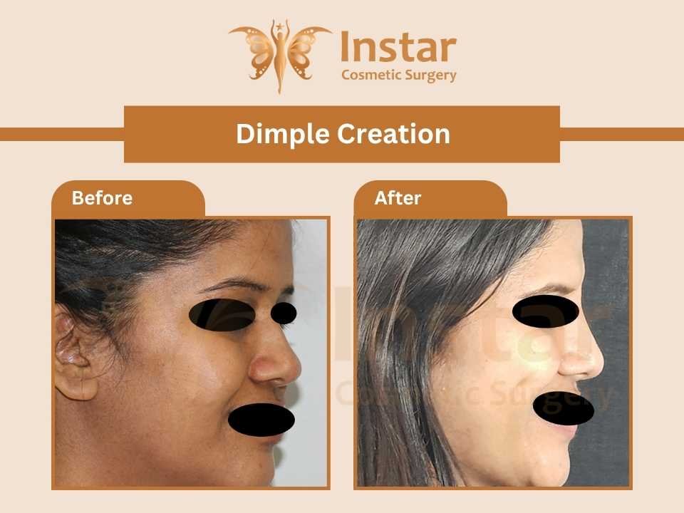 Dimple-creation-3