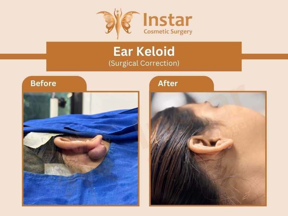 Ear-Keloid-surgical-correction-1