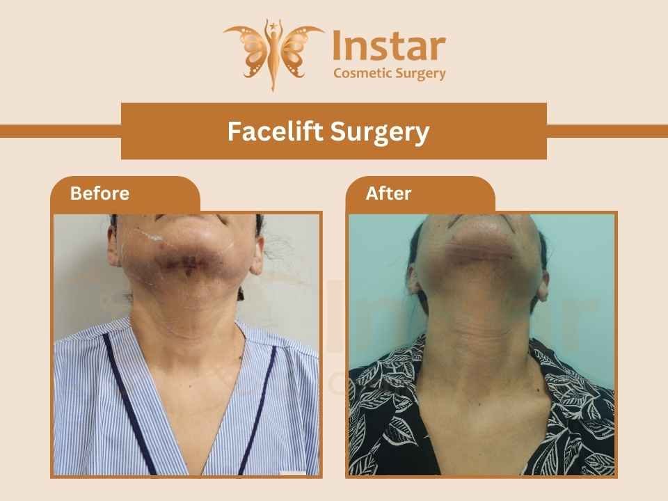 Facelift-Surgery-1