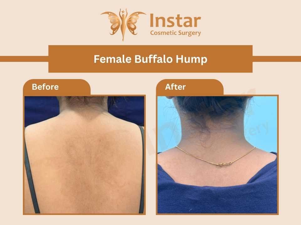 Female-Buffalo-Hump