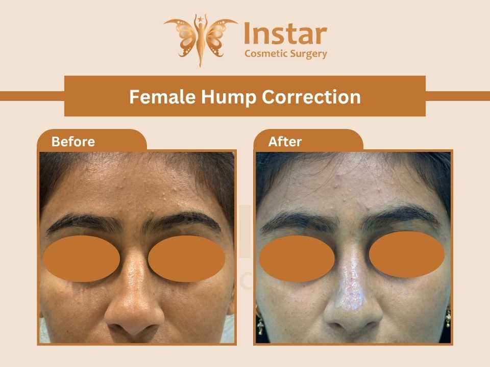 Female-Hump-correction-3