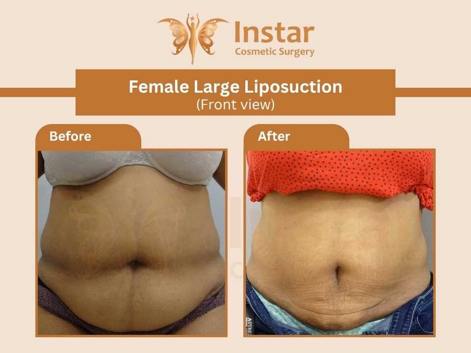 Female-Large-liposuction-front-view