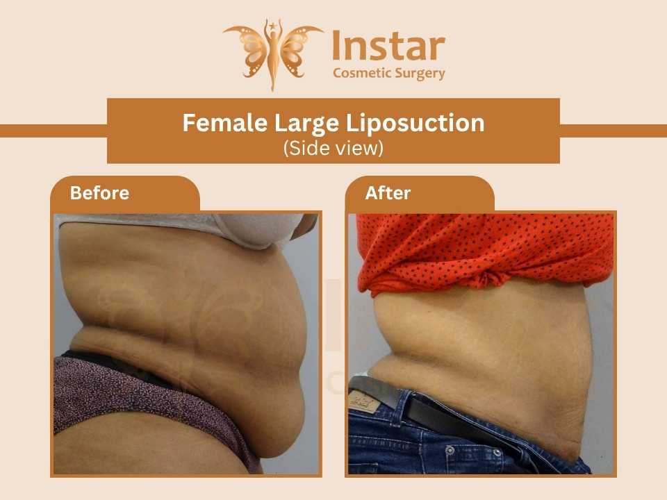Female-Large-liposuction-side-view
