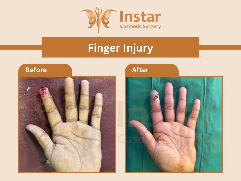 Finger-Injury-2