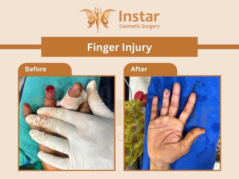 Finger-Injury