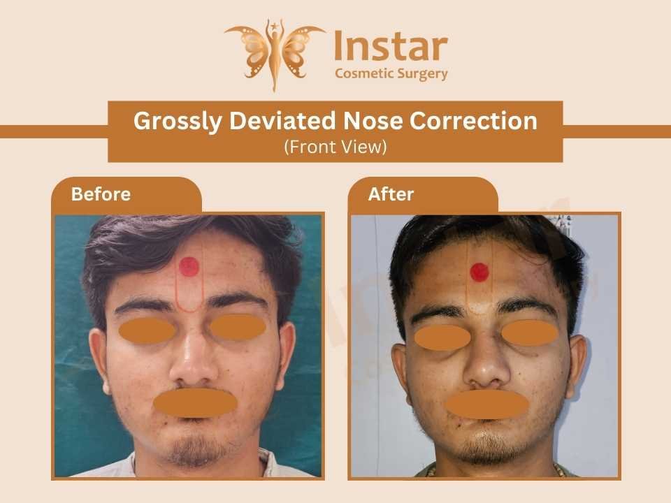 Grossly-Deviated-Nose-Correction-Front-View