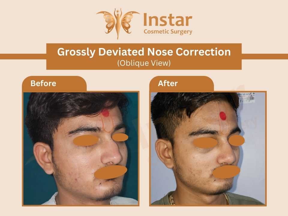 Grossly-Deviated-Nose-Correction-Oblique-View