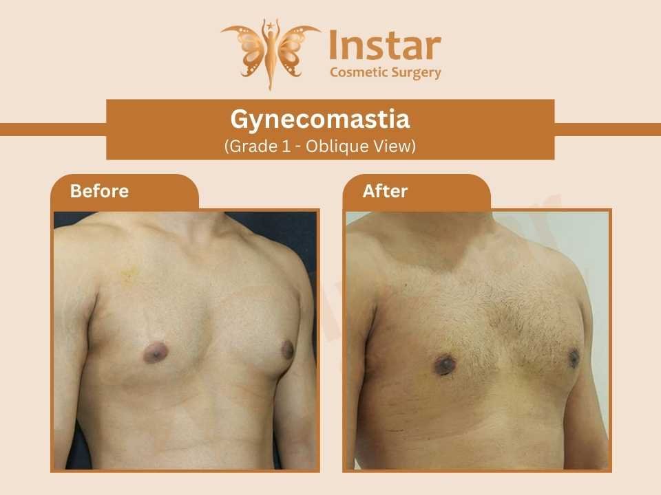Gynecomastia-Grade1-Oblique-View