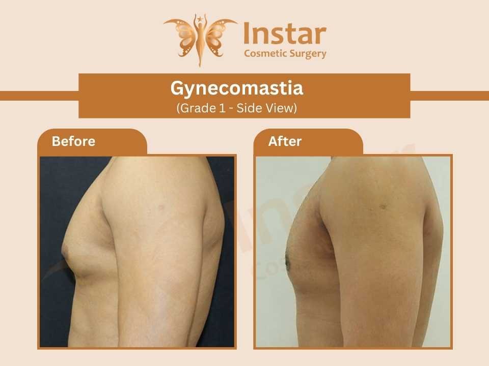 Gynecomastia-Grade1-Side-View