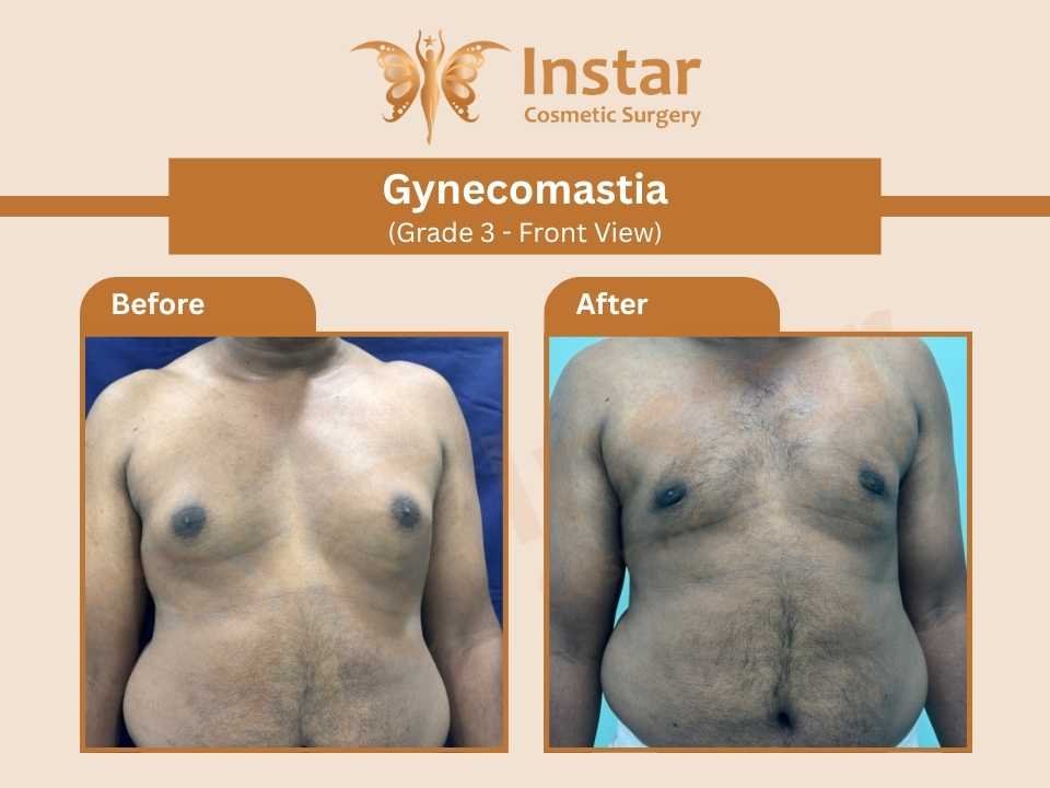 Gynecomastia-Grade3-Front-View