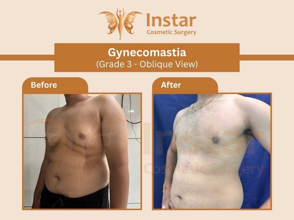 Gynecomastia-Grade3-Oblique-View