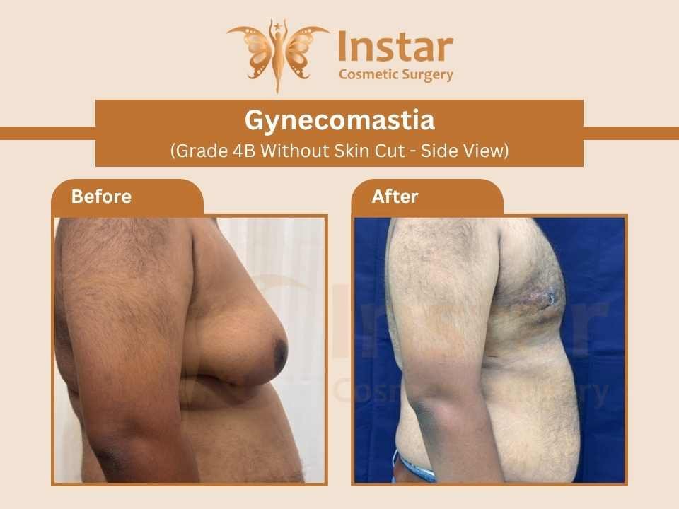 Gynecomastia-Grade4B-Without-Skin-Cut-Side-View
