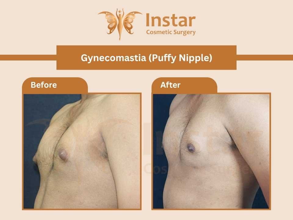 Gynecomastia-puffy-nipple
