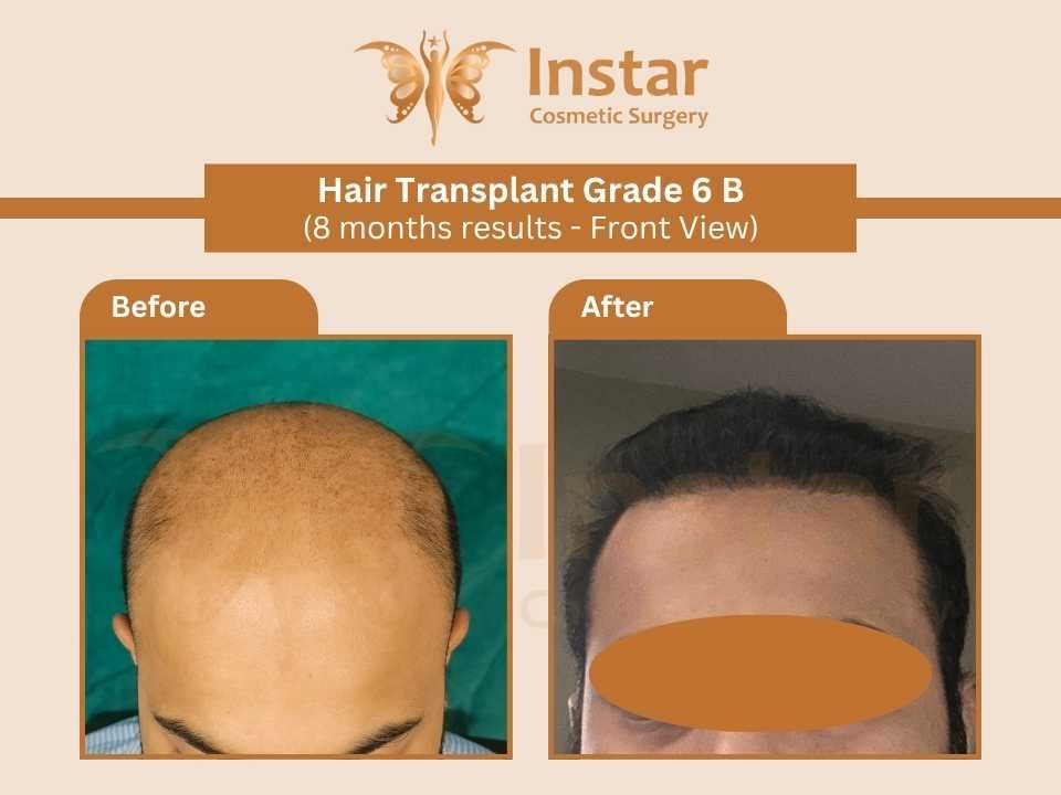 Hair-Transplant-Grade6B-8months-results-Front-View