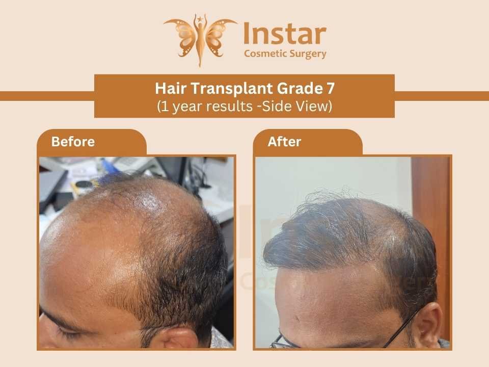 Hair-Transplant-Grade7-1year-results-Side-View