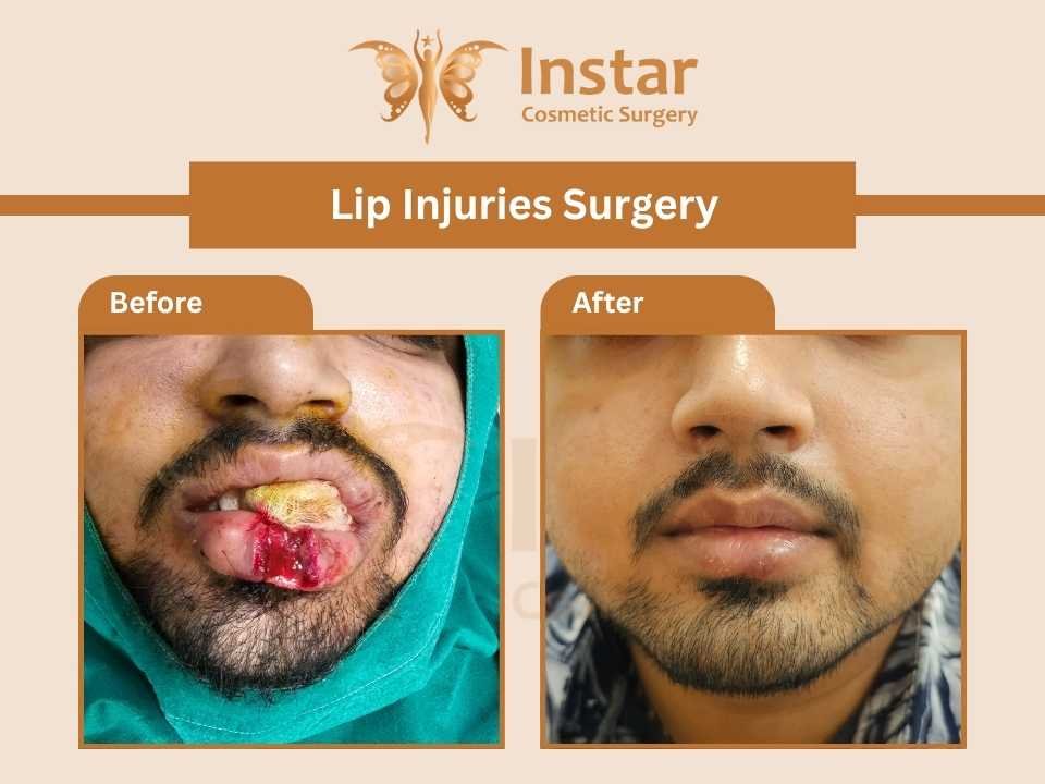 Lip-Injuries-Surgery-1