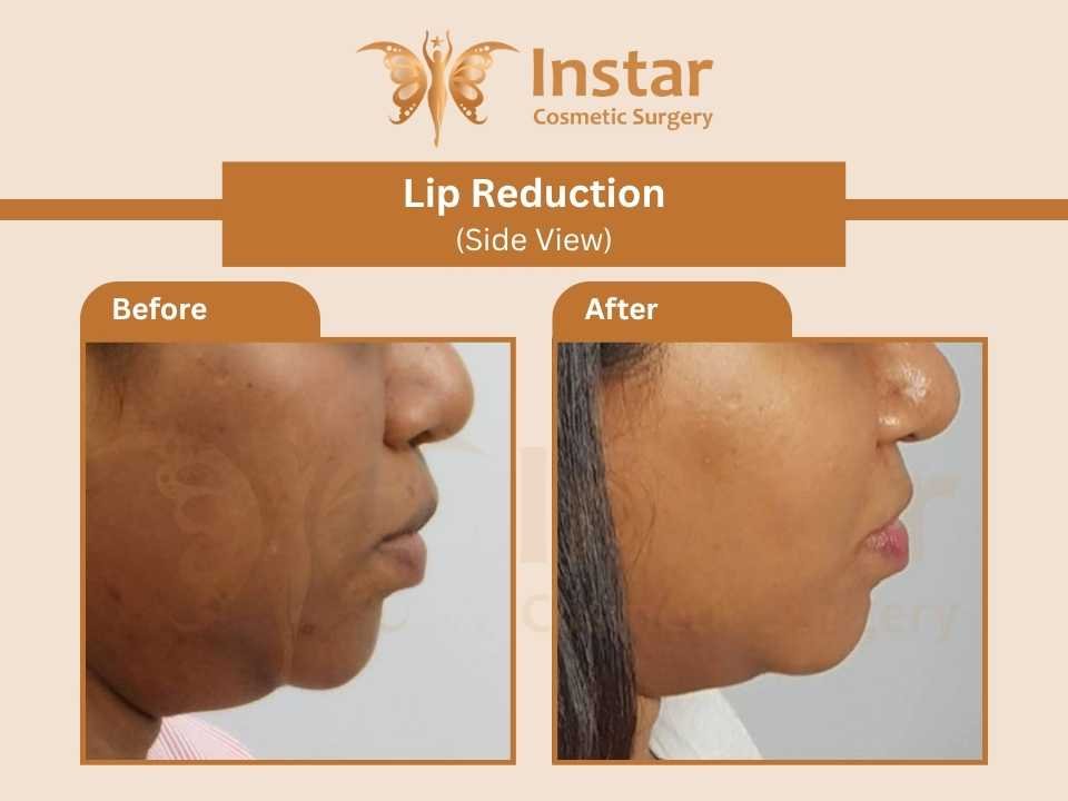 Lip-Reduction-Side-View