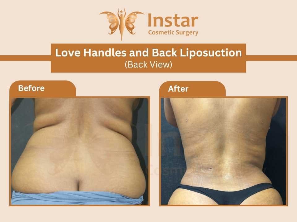 Love-Handles-and-Back-Liposuction-Back-View