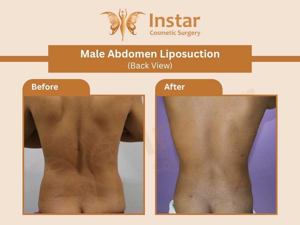 Male-Abdomen-Liposuction-Back-View-2