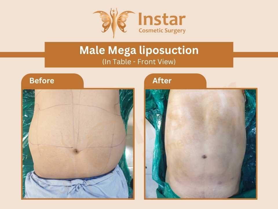 Male-Mega-liposuction-In-Table-Front-View