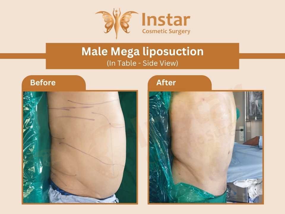 Male-Mega-liposuction-In-Table-Side-View
