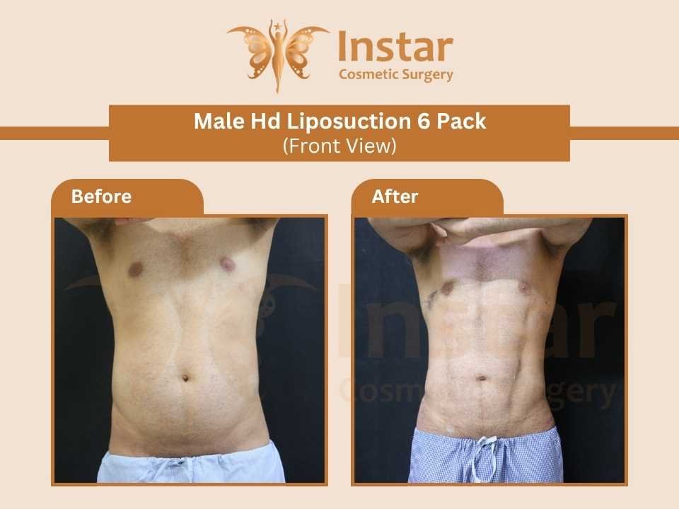 Male-hd-liposuction-6-pack-front-view