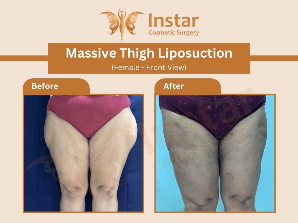 Massive-Thigh-Liposuction-female-front-view