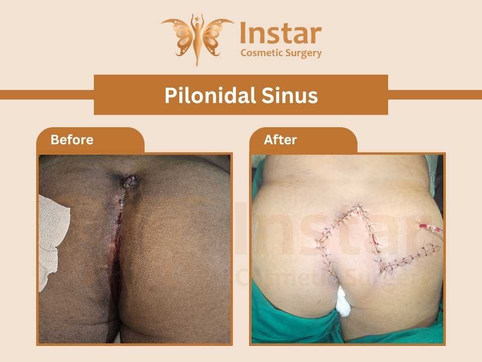 Pilonidal-Sinus-2