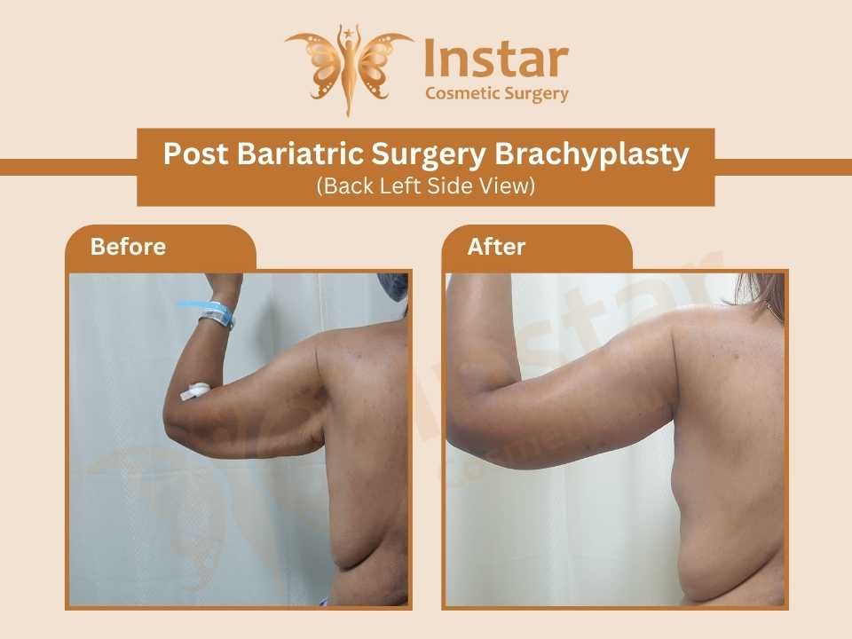 Post-Bariatric-Surgery-Brachyplasty-Back-Left-Side-View
