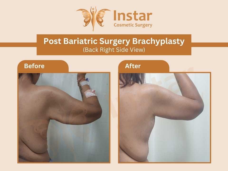 Post-Bariatric-Surgery-Brachyplasty-Back-Right-Side-back-View