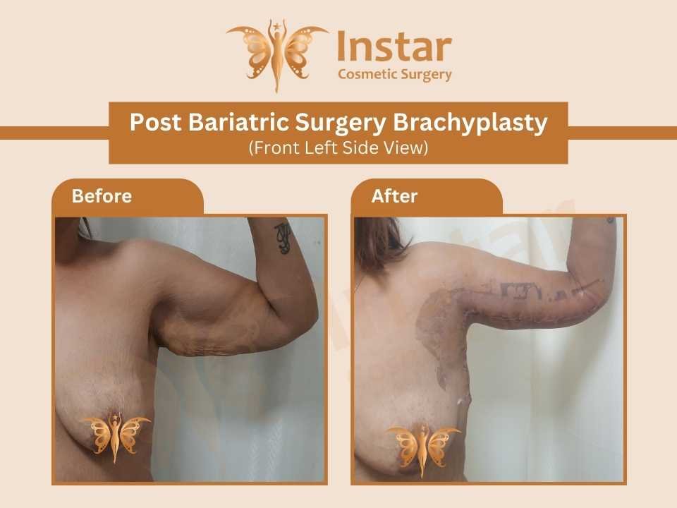 Post-Bariatric-Surgery-Brachyplasty-Front-Right-Side-View