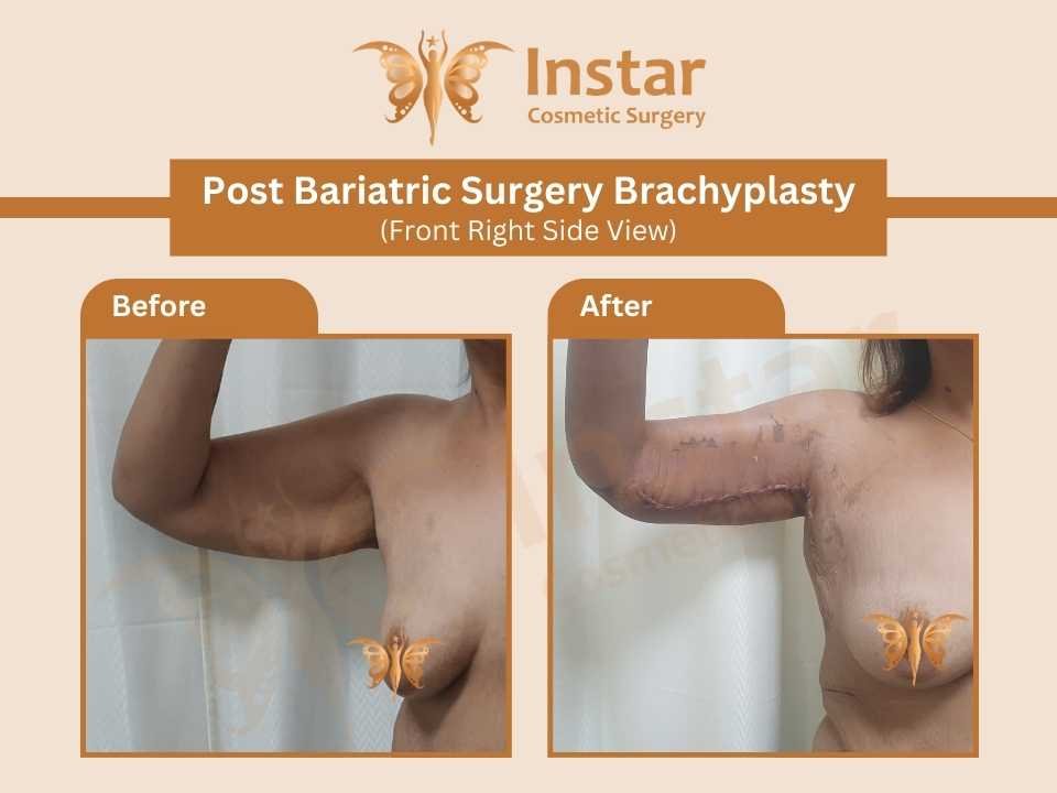 Post-Bariatric-Surgery-Brachyplasty-Front-left-Side-View