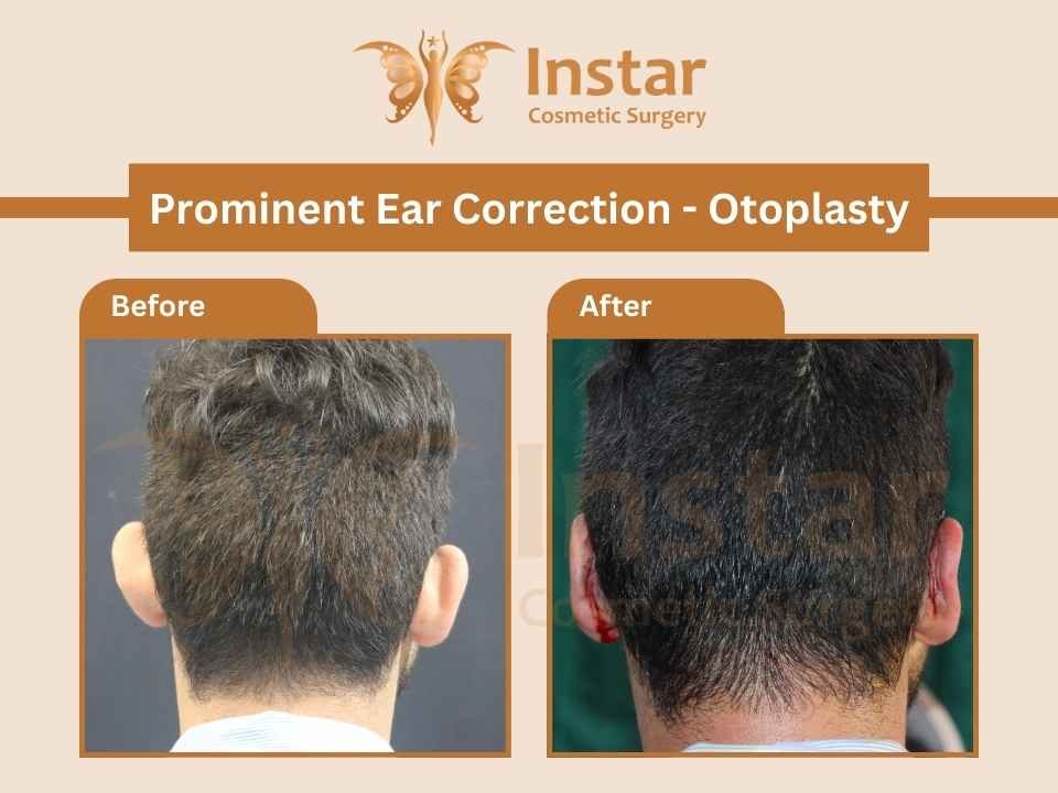 Prominent-ear-correction-Otoplasty