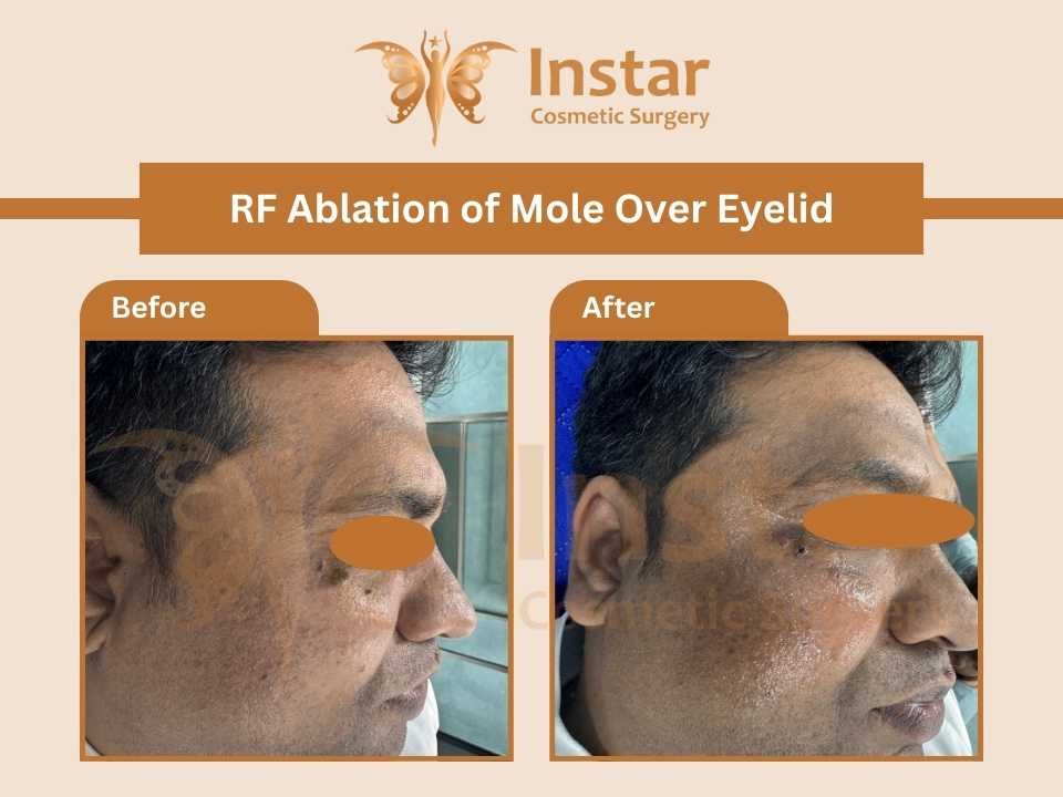 RF-Ablation-of-Mole-Over-Eyelid