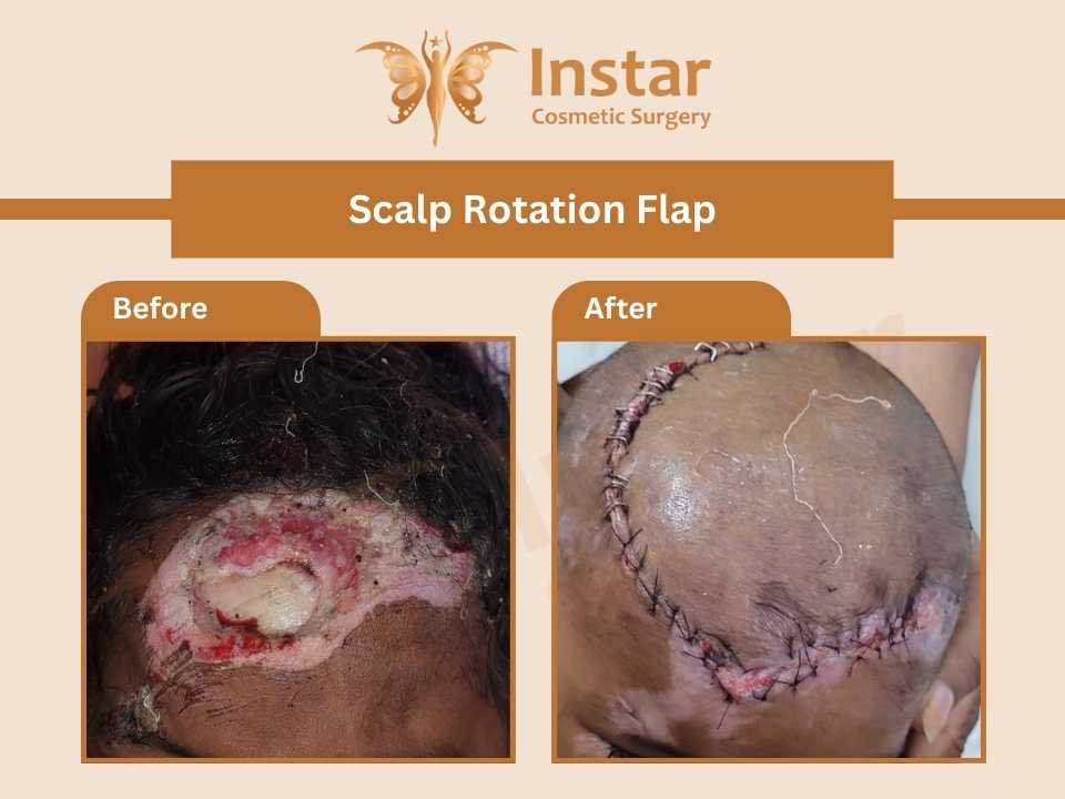 Scalp-rotation-flap-SSG