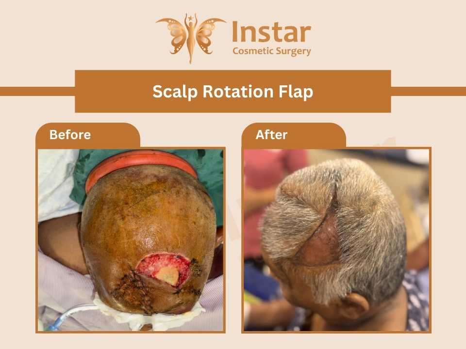 Scalp-rotation-flap-Savitaben