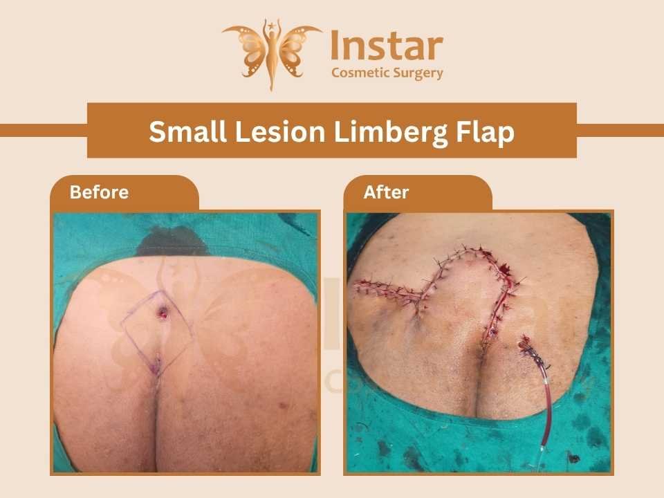 Small-lesion-Limberg-Flap