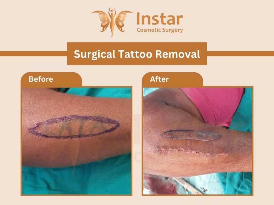 Surgical-Tattoo-Removal