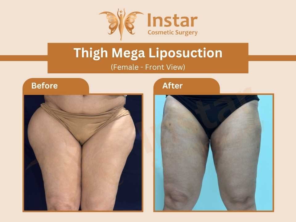 Thigh-Mega-Liposuction-female-front-side-view