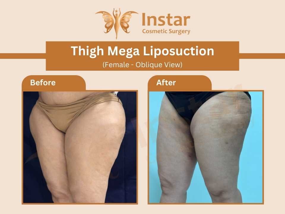 Thigh-Mega-Liposuction-female-oblique-view